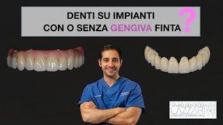 Denti su impianti con o senza gengiva finta [upl. by Missie]