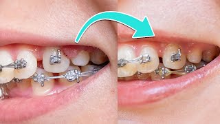 MI EXPERIENCIA CON BRACKETS  ANTES Y DESPUÉS ENCÍAS INFLAMADAS [upl. by Aiyot]