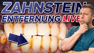 Zahnsteinentfernung LIVE  So läuft es ab Trotz Angst Zahnstein loswerden ✅ [upl. by Ilana]