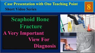 Scaphoid Bone Fracture Case Presentation with One Teaching Point [upl. by Hgielek]