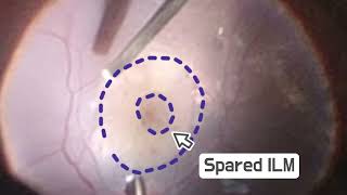 Fovea Sparing ILM Peeling  Foveoschisis  ILM Peeling with RRD  PPV  Dr Muthanna Basheer [upl. by Feldt657]