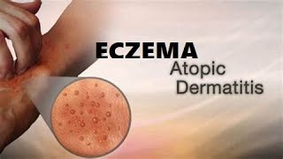 What is Eczema A Type of skin condition I Atopic Dermatitis I Allergic eczema I Neurodermatitis [upl. by Marielle]