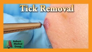 Dead Tick Removal  Auburn Medical Group [upl. by Ayeki]