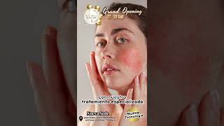 Láser para Rosácea rosacea rosaceatreatment laser [upl. by Novej]