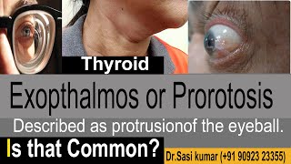 Exopthalmos or Prorotosis  Described as protrusion of the eyeball [upl. by Siravat226]