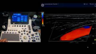 Farbkodierte Duplexsonographie 11SchrittMethode [upl. by Wernher]