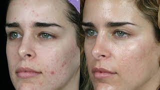 ELIMINA EL ACNE CON AZUFRE – RESULTADOS INCREIBLES [upl. by Maharg632]