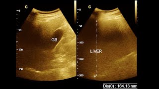 Hepatomegaly  Mild hepatomegaly with fatty change  Ultrasonography report  Amader Hospital [upl. by Abehsat]