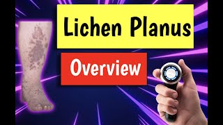 Lichen planus causes treatment diagnosis management [upl. by Mabel911]