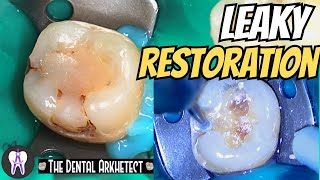 Replacing an Old Restoration While Preventing Recurrent Caries C43 4k [upl. by Llemor]