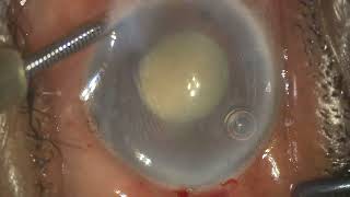 Surgical management of phacomorphic glaucoma with zonular weakness [upl. by Cinomod]