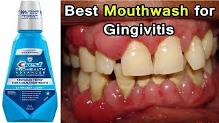 Top 3 Best Mouthwashes for Gingivitis Disease  Periodontal Disease [upl. by Demah920]