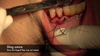 Treatment of a Periodontal Abscess [upl. by Ruthann750]