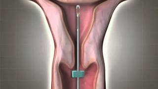 IUD INSERTION [upl. by Ainoet]