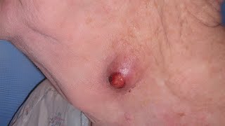 Inflamed Cyst with Ulceration  Keratin Granuloma [upl. by Brock518]