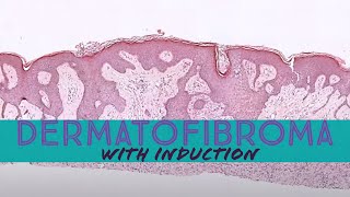 Dermatofibroma with induction phenomenon pathology dermpath dermatology dermatopathology [upl. by Suired]