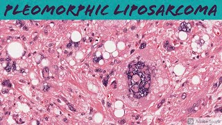 Pleomorphic Liposarcoma 5Minute Pathology Pearls [upl. by Liatrice]