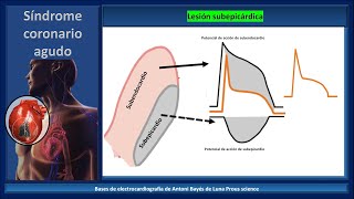 Electrocardiograma isquemia lesión necrosis y criterios de Sgarbossa [upl. by Aitnis959]