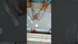 Atrophic uterus specimen அட்ராபிக் கருப்பை  biopsy satisfying pathology histopathology [upl. by Bruckner675]