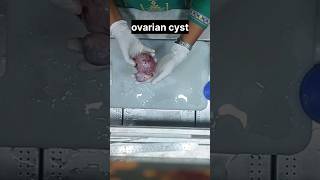 Ovarian cyst  histopathology ovariancyst cyst  ovariancancer histology [upl. by Willis]