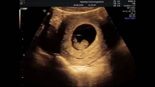 9 Weeks Ultrasound  8 weeks 4 days Technically [upl. by Araj]