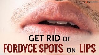 12 Ways To Get Rid Of Fordyce Spots On Lips  Healthspectra [upl. by Adnesor246]