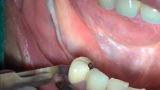 Apical repostioned flap [upl. by Chasse]