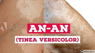 Anan  Sanhi Sintomas At Gamot Para Sa Tinea Versicolor [upl. by Wallie]