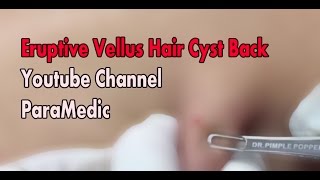 Eruptive Vellus Hair Cyst Back [upl. by Taddeusz]