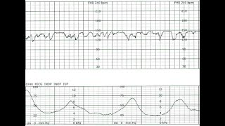 Fetal Monitoring Segment 2 Uterine Contractions [upl. by Idnar]