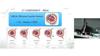 Leaflet Thrombosis in TAVI  Prof Greg Scalia [upl. by Ilocin]