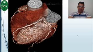 Angiotomografia de coronárias [upl. by Robi]