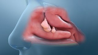 Nasal Polyp Removal Surgery [upl. by Lenahs]