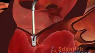 Cardiology  Mitral Valve Clip [upl. by Anassor795]