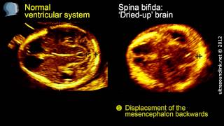 Spina bifida 3D ultrasound diagnosis at 1113 weeks [upl. by Darrow993]