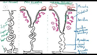 Preeclampsia [upl. by Baptista904]