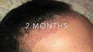 Trapianto Capelli Giorno per Giorno da giorno 1 a 6 mesi  Hair transplant Day By Day [upl. by Alecram]