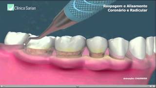Raspagem e Alisamento Coronário e Radicular [upl. by Eannej]