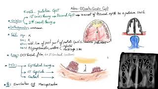 cyst revison 2 non odontogenic [upl. by Colston]