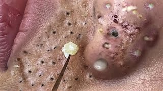 Blackhead Removal With Sac Dep Spa 1000312 [upl. by Nelo892]