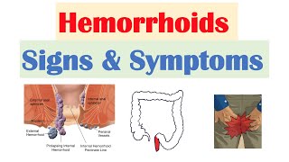 Hemorrhoids Signs amp Symptoms  Internal vs External Hemorrhoid Symptoms  Hemorrhoidal Disease [upl. by Sirovat]