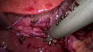 Laparoscopic Cholecystectomy 24 anam [upl. by Bloom]