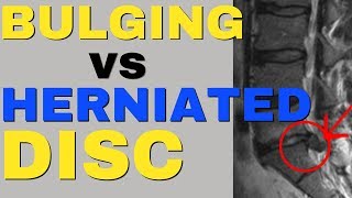 What Is The Difference Between A Bulging Disc And A Herniated Disc Bulging Disc vs Herniated Disc [upl. by Hannan948]