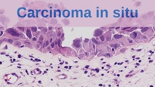 Topic Carcinoma in situ Medical surgical nursing Bsc nursing 2nd year [upl. by Llenaj]