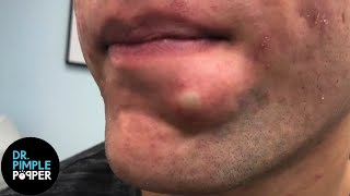 SATISFYING Dr Lee Pops Inflamed Cyst on Chin  Dr Pimple Popper Reacts [upl. by Hamil]