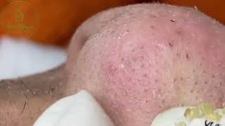 Loan Nguyen Acne Treatment 00037 [upl. by Dixie]