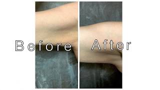 Tighten Flabby Arms amp Remove Stretch Marks [upl. by Acissej874]