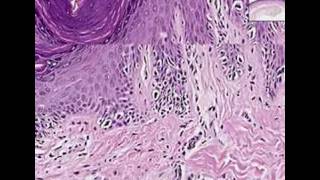 Histopathology SkinMelanoma in situ [upl. by Netloc]