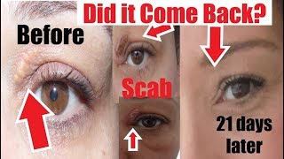 Has Xanthelasma Come Back Before amp After Xanthelasma Removal at Home I show My Scar after Removal [upl. by Catharine]