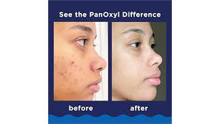 PanOxyl Acne Foaming Wash Review Is 10 Benzoyl Peroxide Worth the Hype [upl. by Eednam]